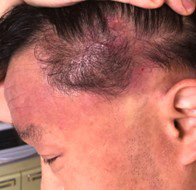 おでこ、こめかみ、頭皮、耳周囲などが真っ赤に腫れてボコボコでした